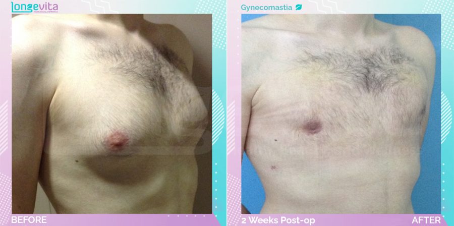 Gynecomastia before and after, Breast
