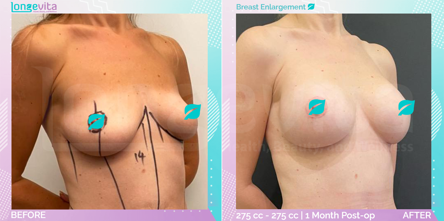 Breast Enlargement before and after, Breast