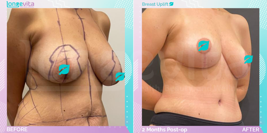 Breast Lift before and after, Breast