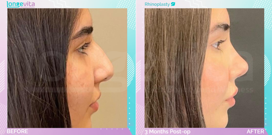 Rhinoplasty before and after, Face