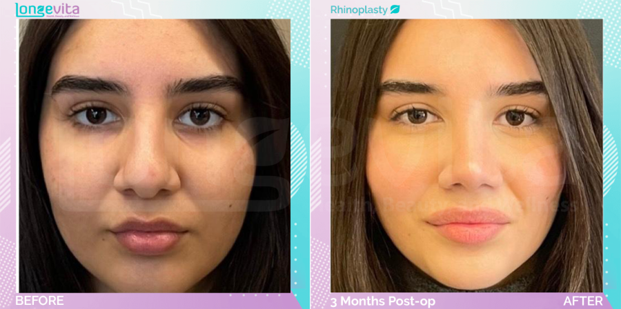 Rhinoplasty before and after, Face