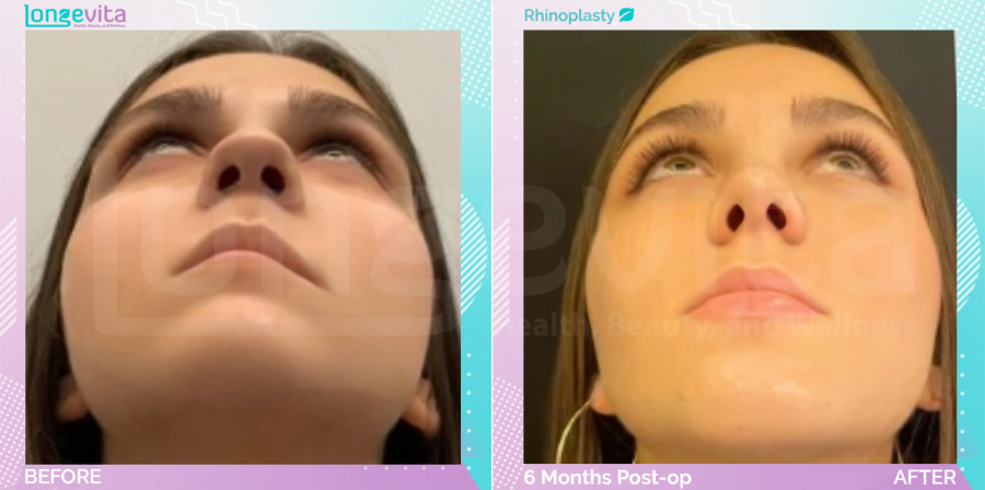 Rhinoplasty before and after, Face