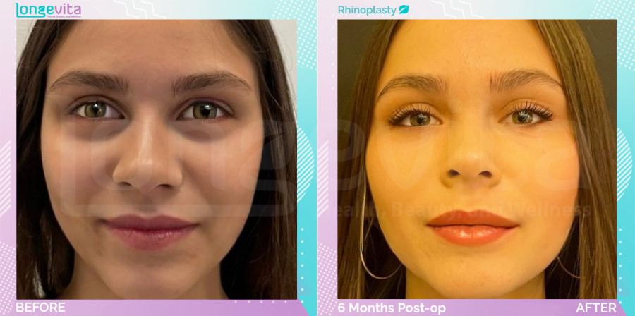Rhinoplasty before and after, Face