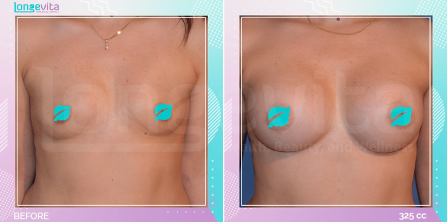 Breast Enlargement before and after, Breast