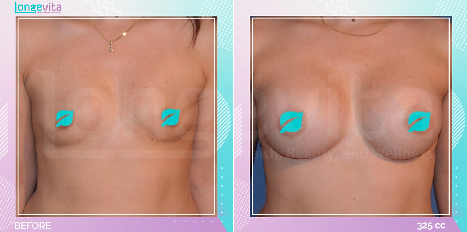 Breast Enlargement before and after, Breast