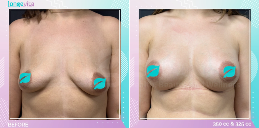 Breast Enlargement before and after, Breast