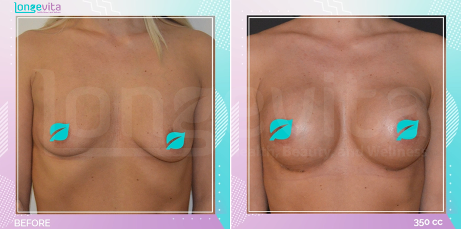 Breast Enlargement before and after, Breast