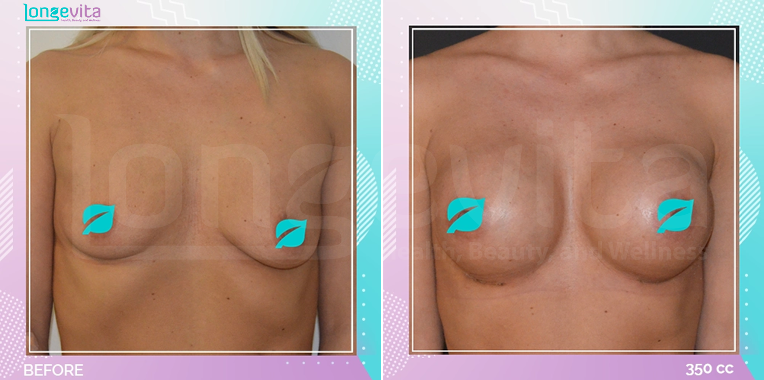 Breast Enlargement before and after, Breast