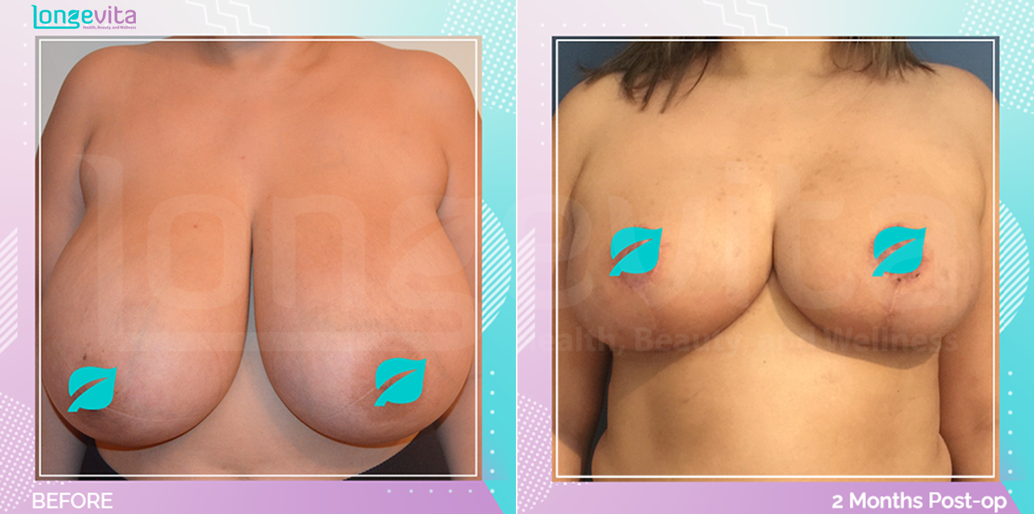 Breast Reduction before and after, Breast