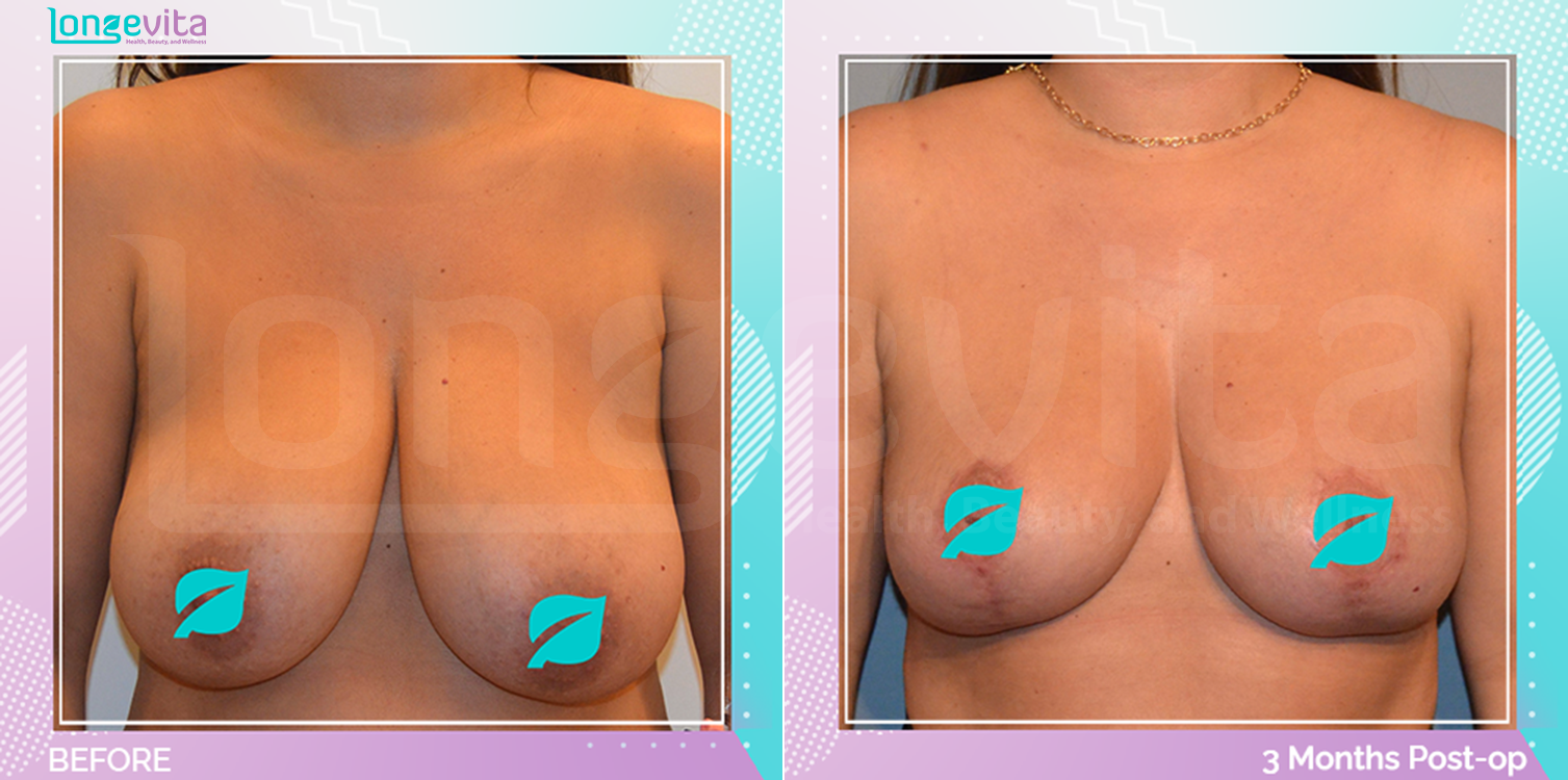 Breast Reduction before and after, Breast