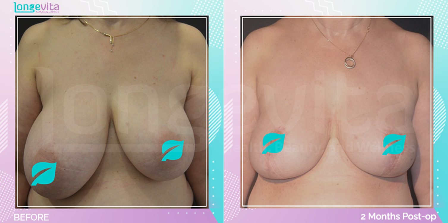 Breast Reduction before and after, Breast