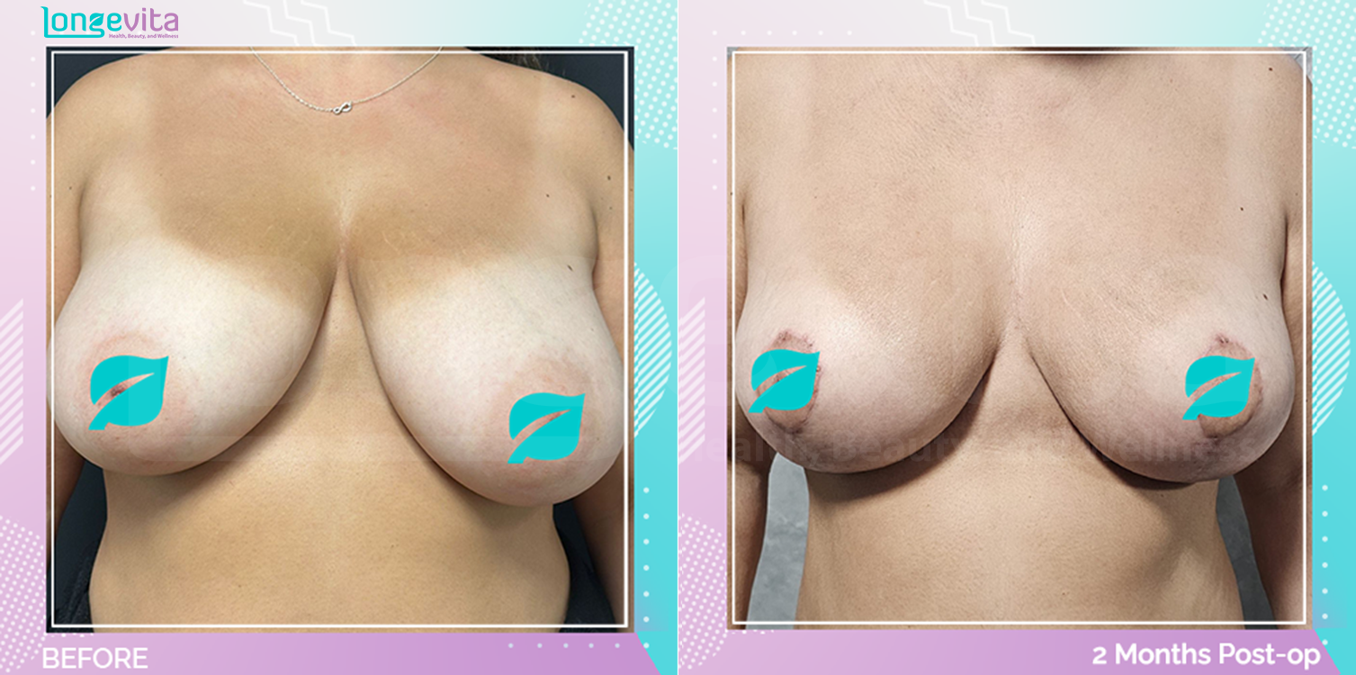 Breast Reduction before and after, Breast