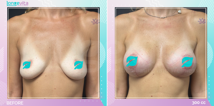 Breast Enlargement and Breast Lift before and after, Breast