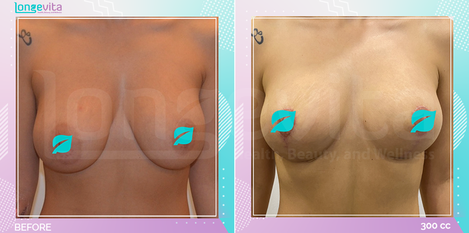 Breast Enlargement and Breast Lift before and after, Breast