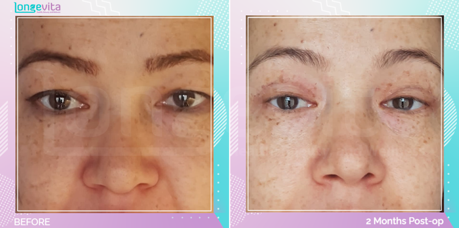 Eyelid before and after, Face