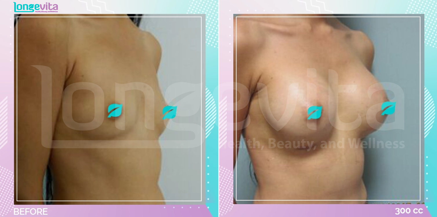 Breast Enlargement before and after, Breast