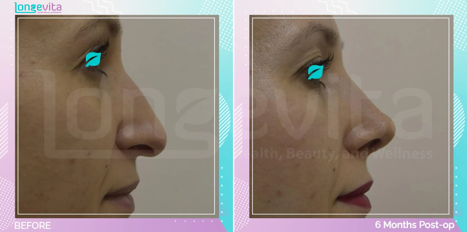 Rhinoplasty before and after, Face