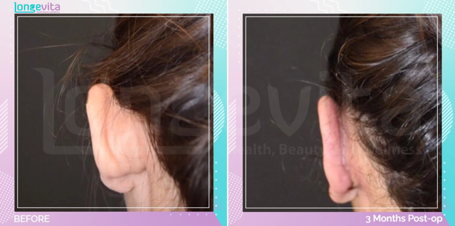 Otoplasty before and after, Face