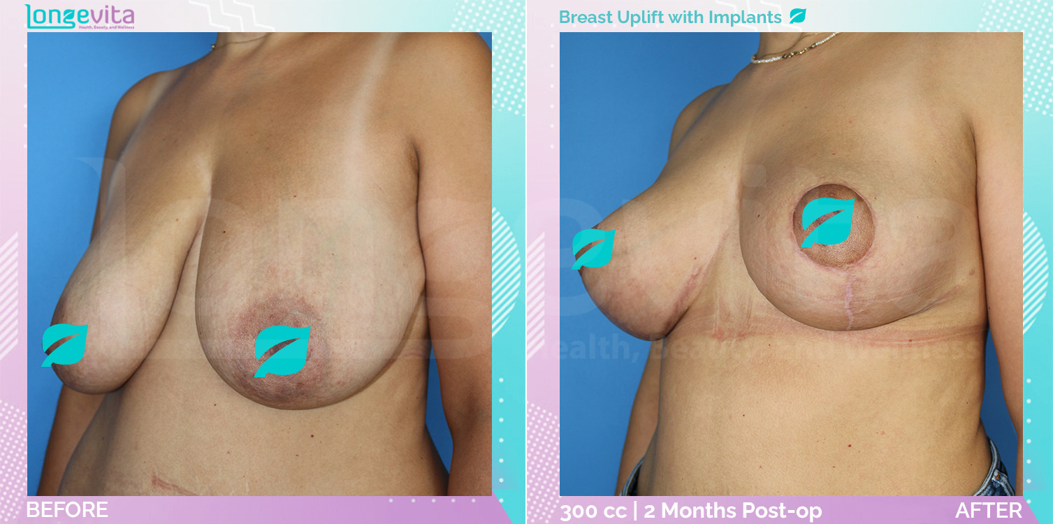 Breast Enlargement and Breast Lift before and after, Breast