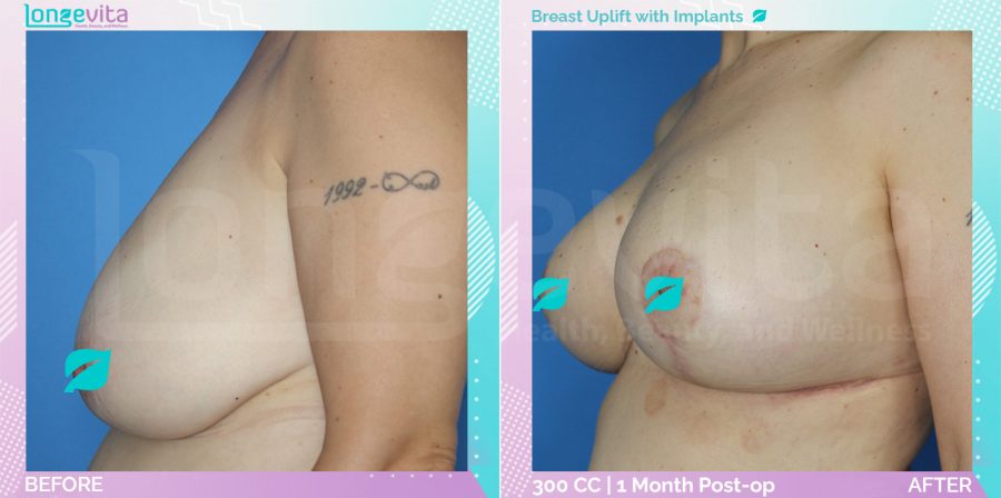 Breast Enlargement and Breast Lift before and after, Breast
