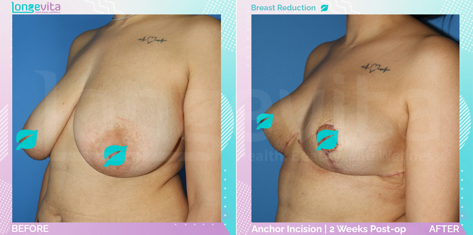 Breast Reduction before and after, Breast