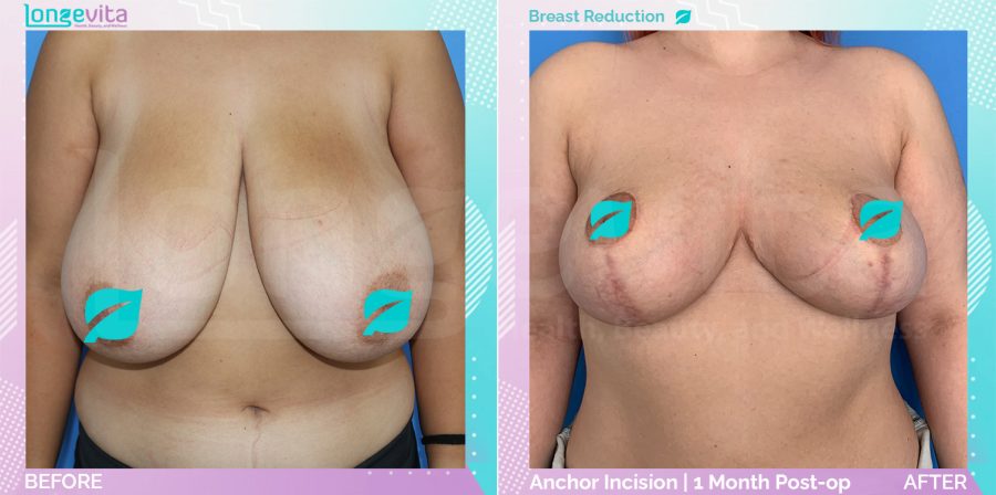 Breast Reduction before and after, Breast