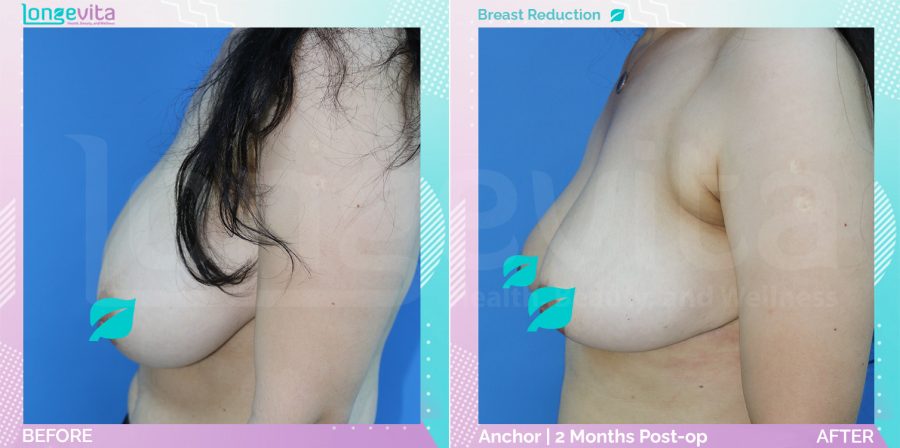 Breast Reduction before and after, Breast