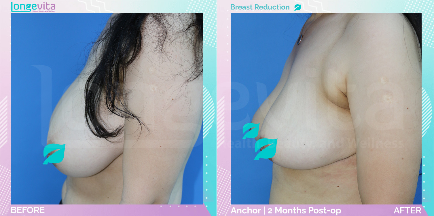 Breast Reduction before and after, Breast