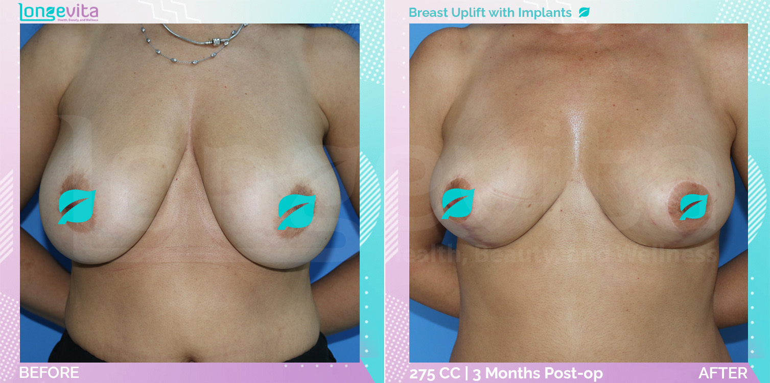 Breast Enlargement and Breast Lift before and after, Breast