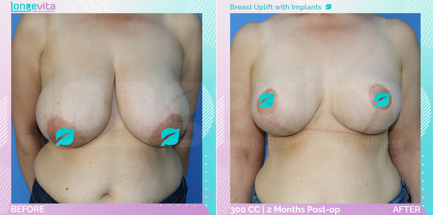 Breast Enlargement and Breast Lift before and after, Breast