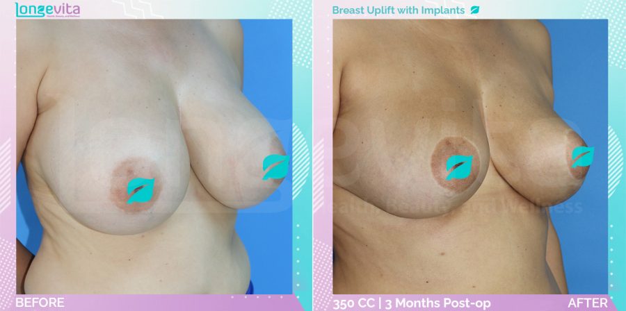 Breast Enlargement and Breast Lift before and after, Breast