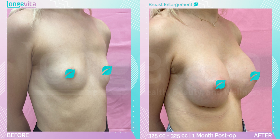 Breast Enlargement before and after, Breast