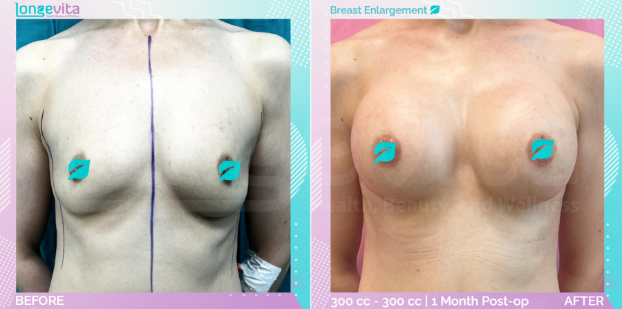 Breast Enlargement before and after, Breast