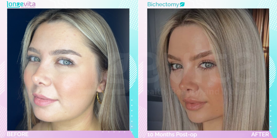 Bichectomy before and after, Face