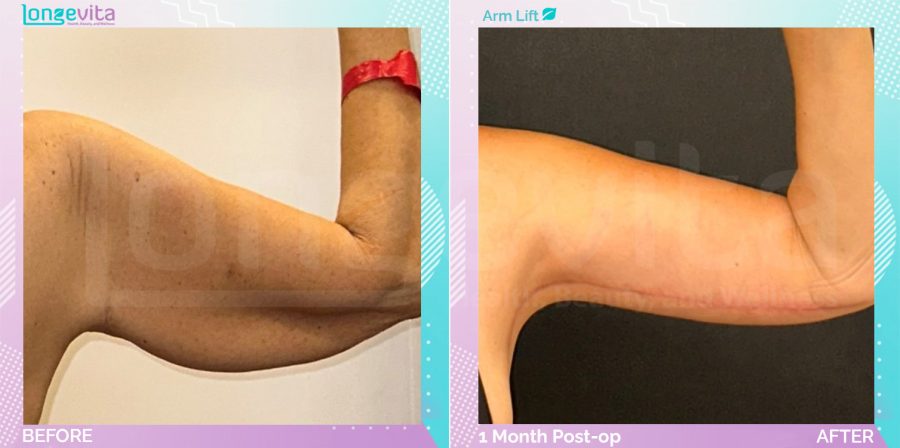 Arm Lift before and after, Body