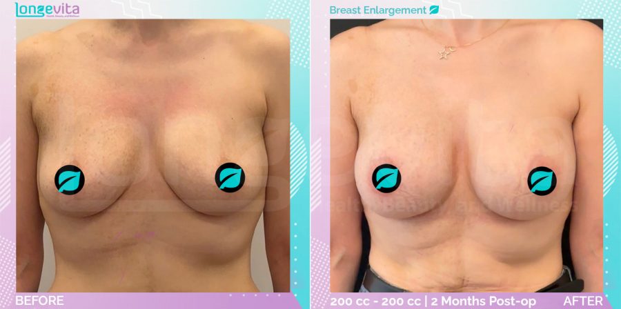 Breast Enlargement before and after, Breast