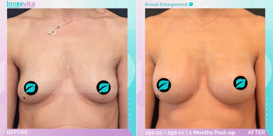 Breast Enlargement before and after, Breast