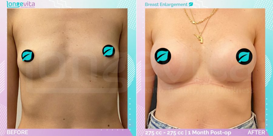 Breast Enlargement before and after, Breast