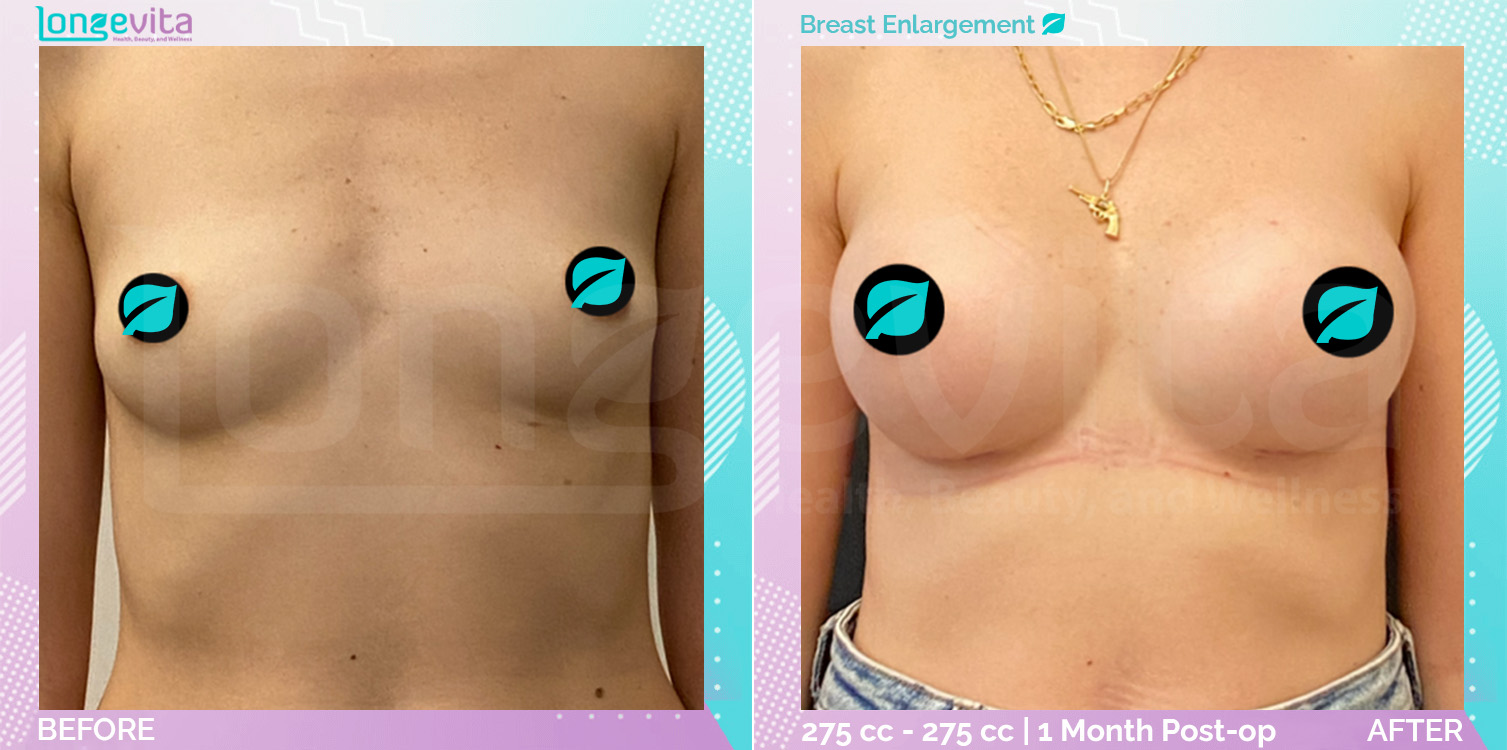 Breast Enlargement before and after, Breast