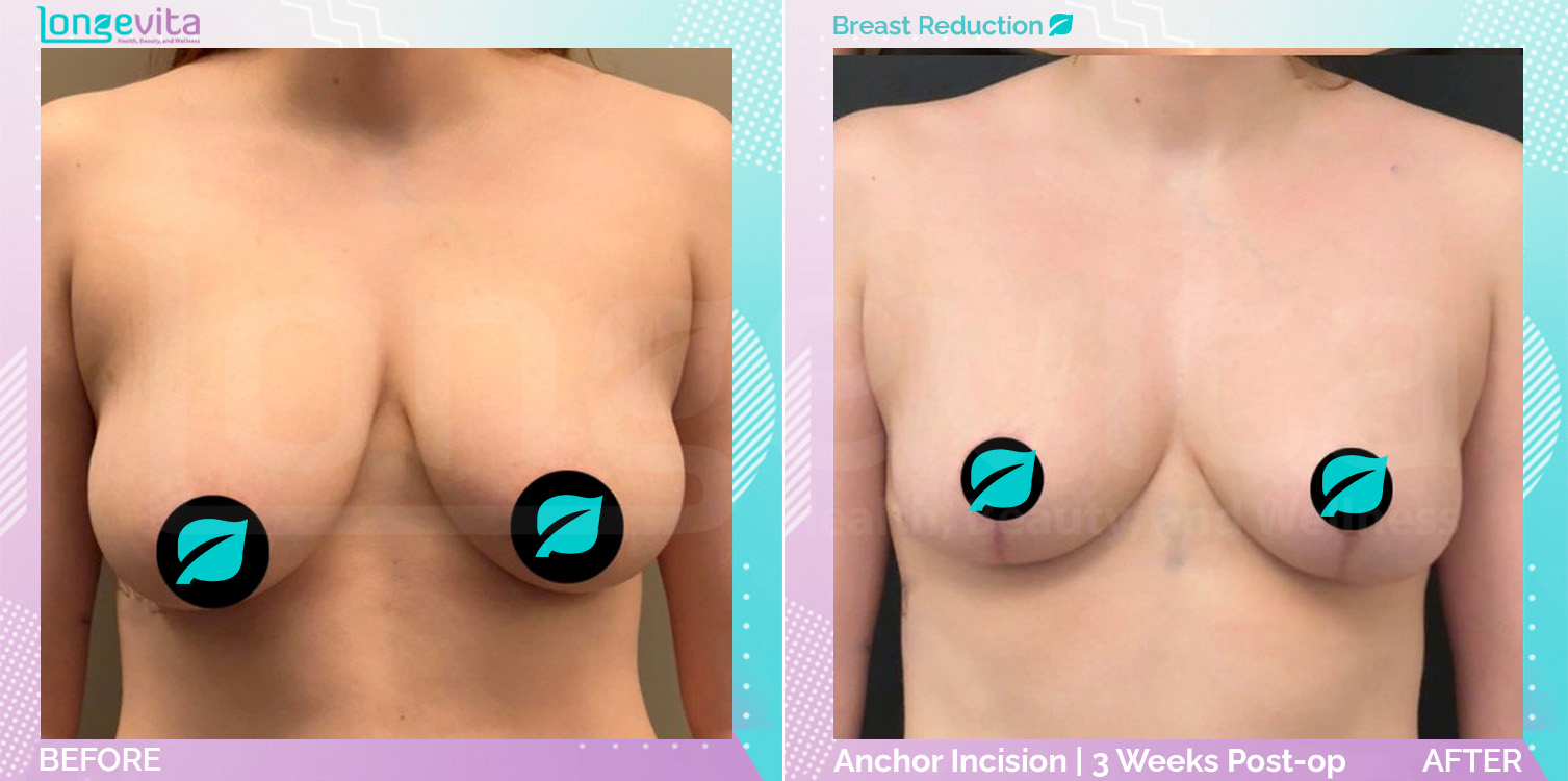 Breast Reduction before and after, Breast