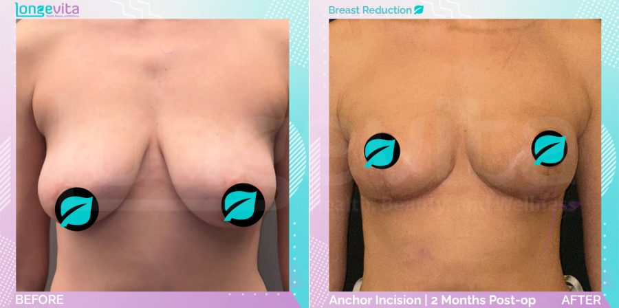 Breast Reduction before and after, Breast