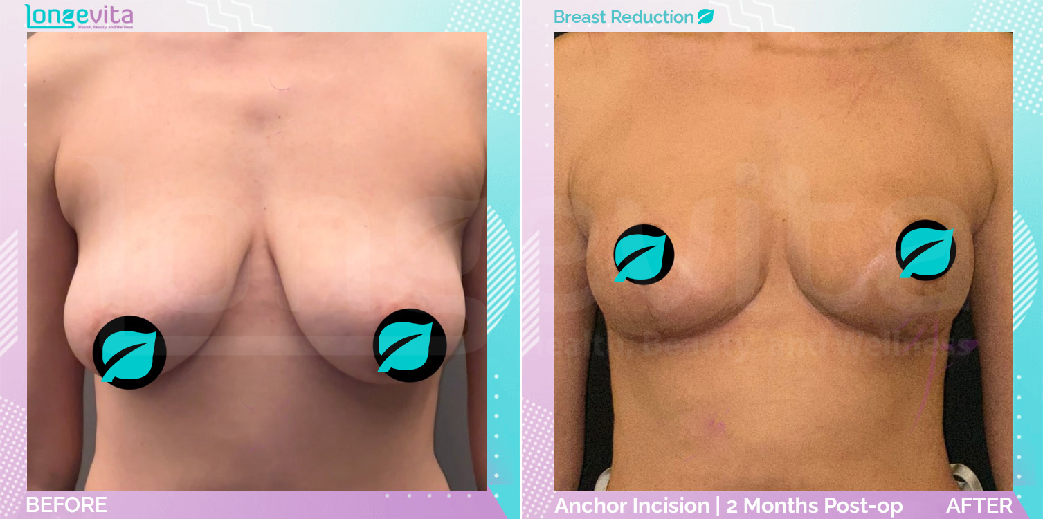 Breast Reduction before and after, Breast