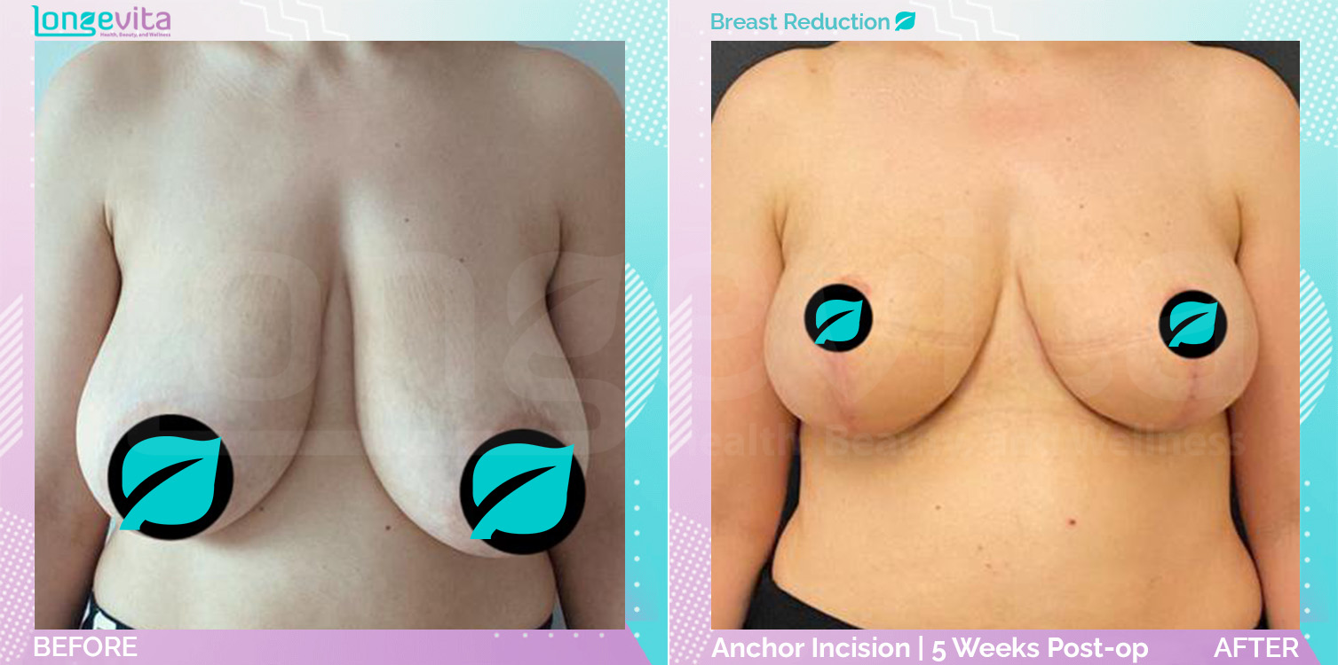 Breast Reduction before and after, Breast