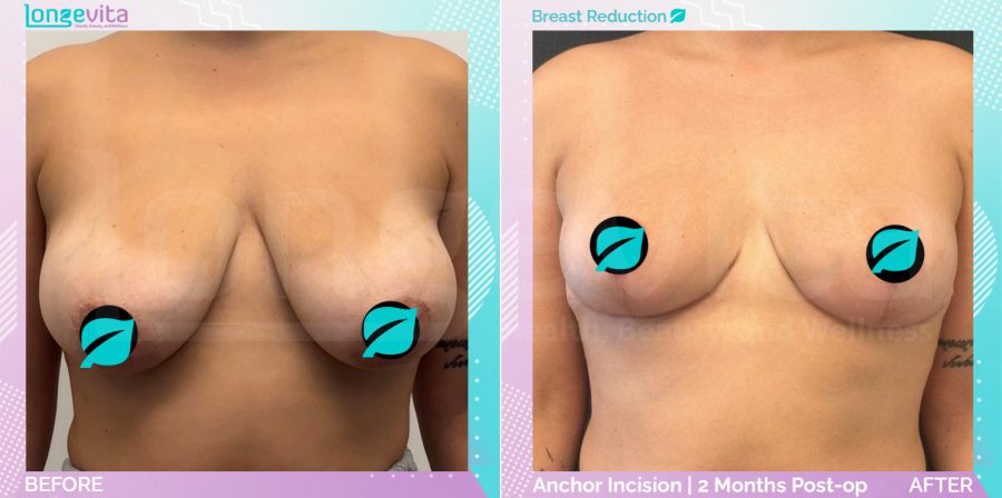 Breast Reduction before and after, Breast