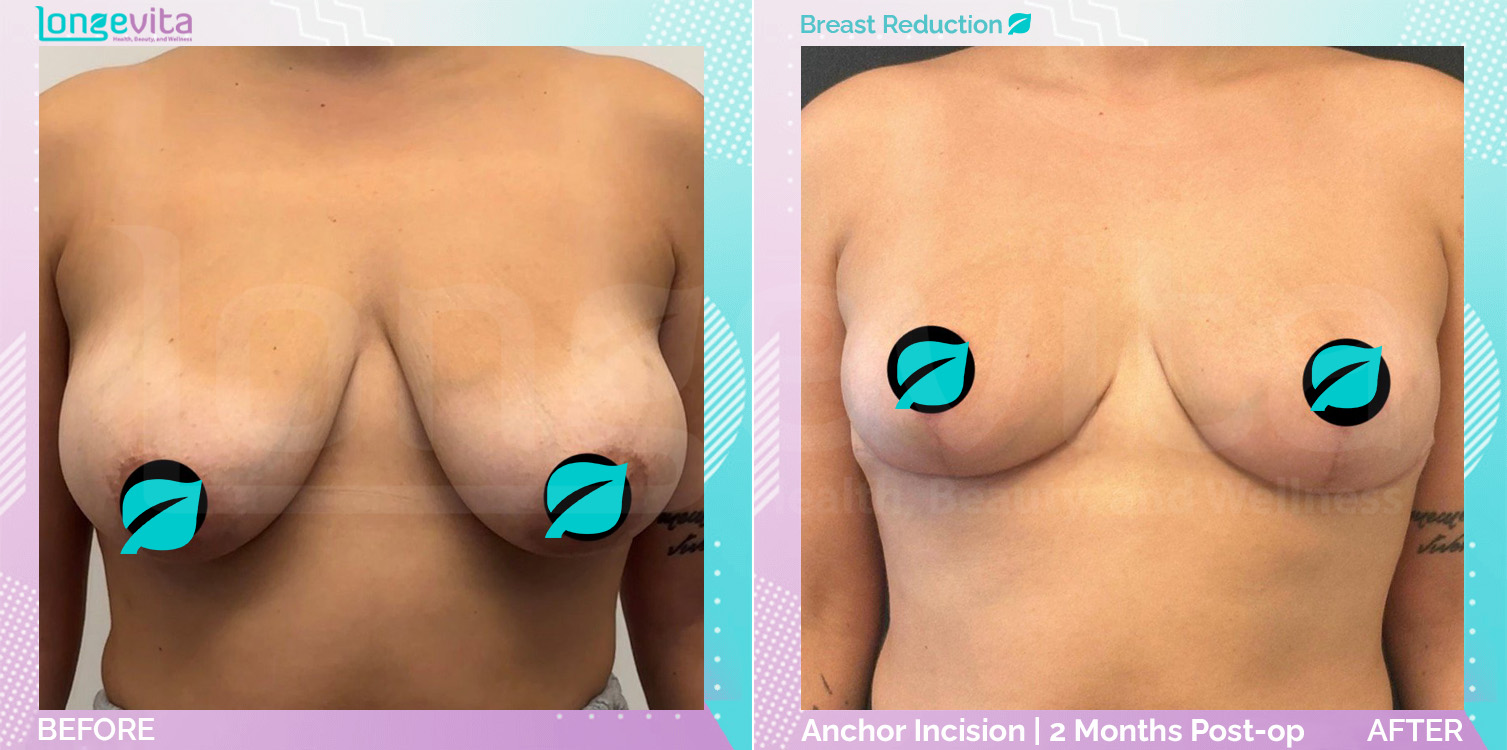 Breast Reduction before and after, Breast