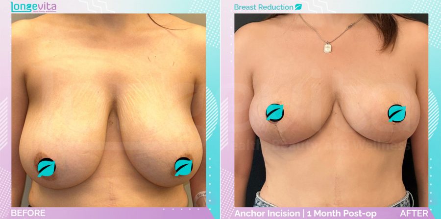 Breast Reduction before and after, Breast