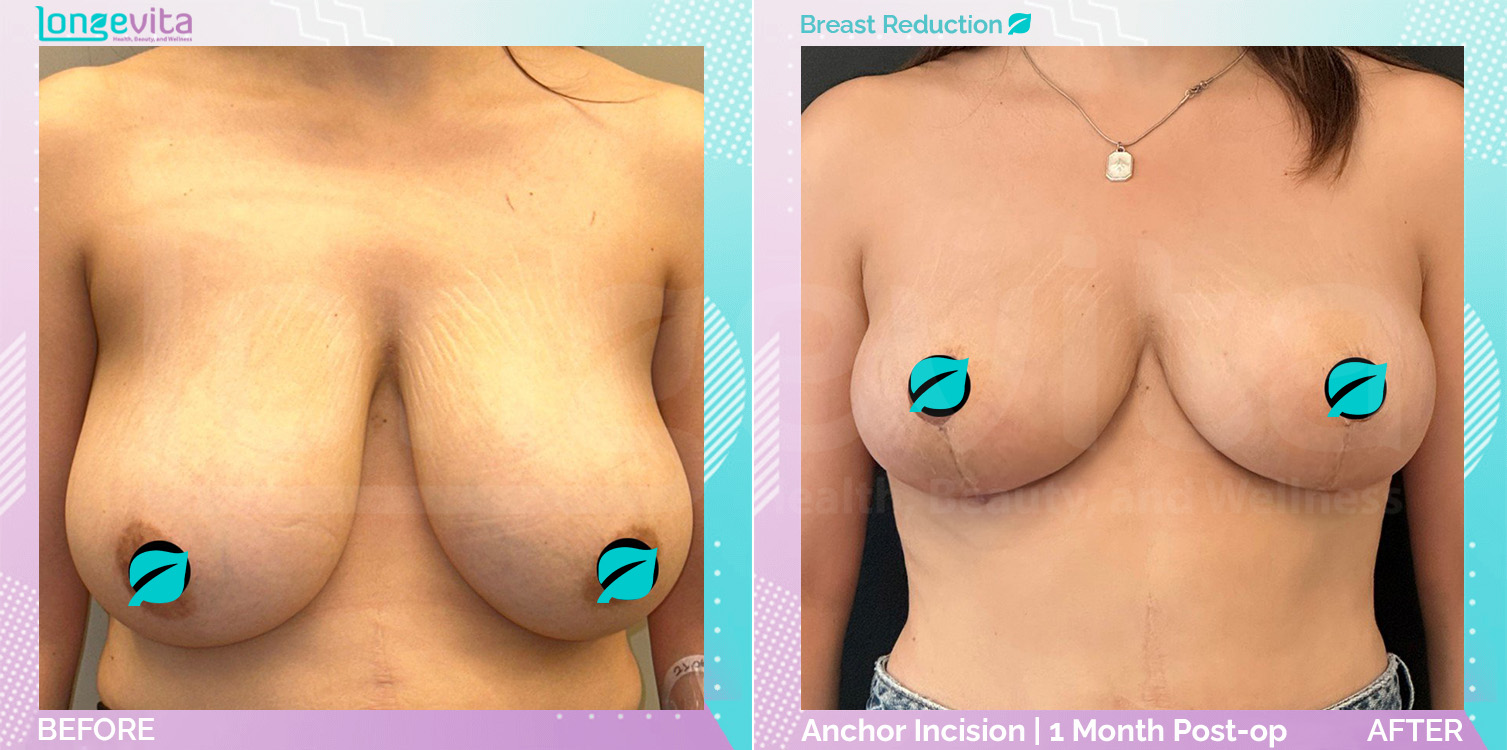 Breast Reduction before and after, Breast