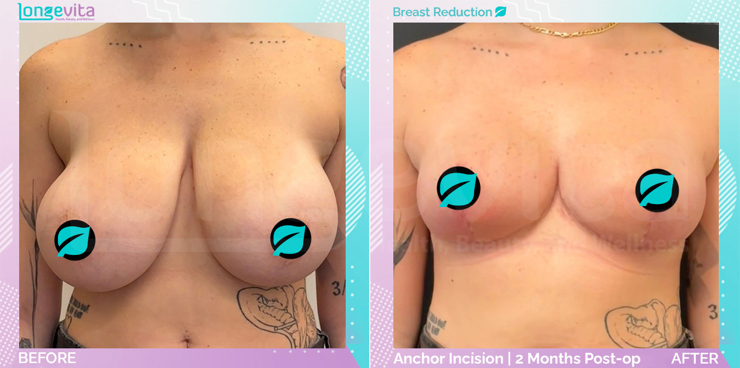 Breast Reduction before and after, Breast