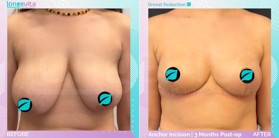 Breast Reduction before and after, Breast
