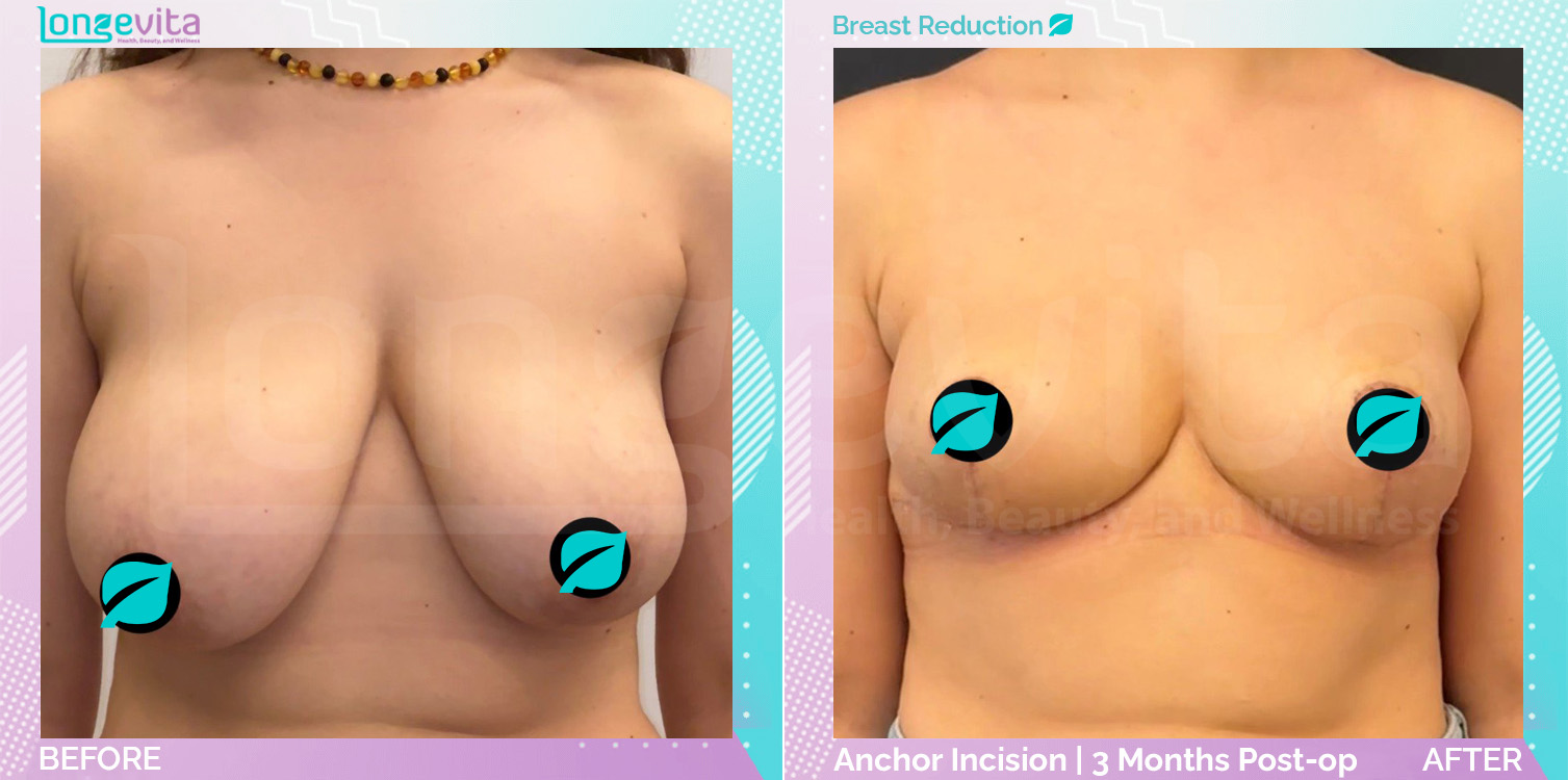 Breast Reduction before and after, Breast
